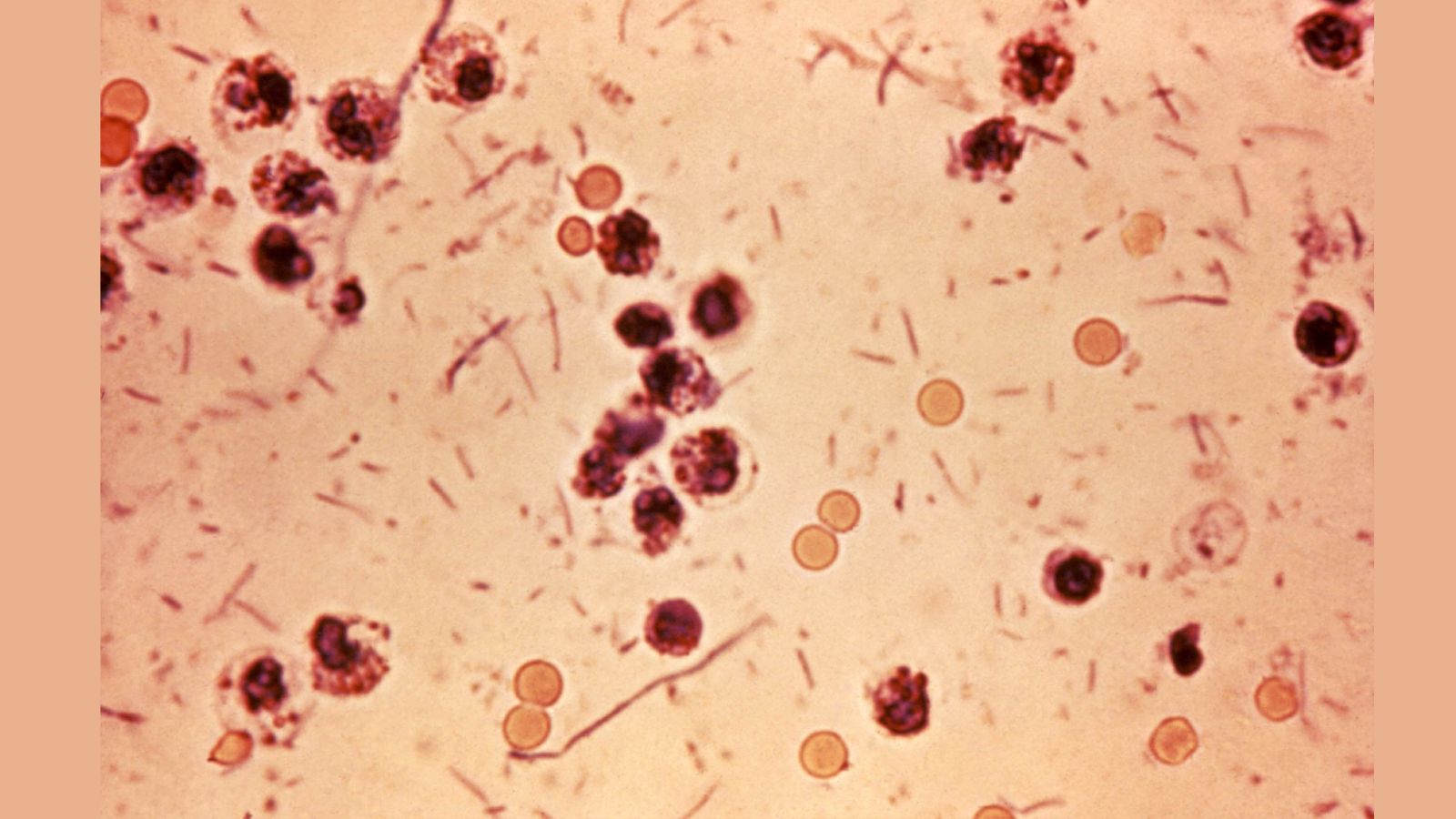 Kerala reports eight more Shigella cases as June tally rises to 180
